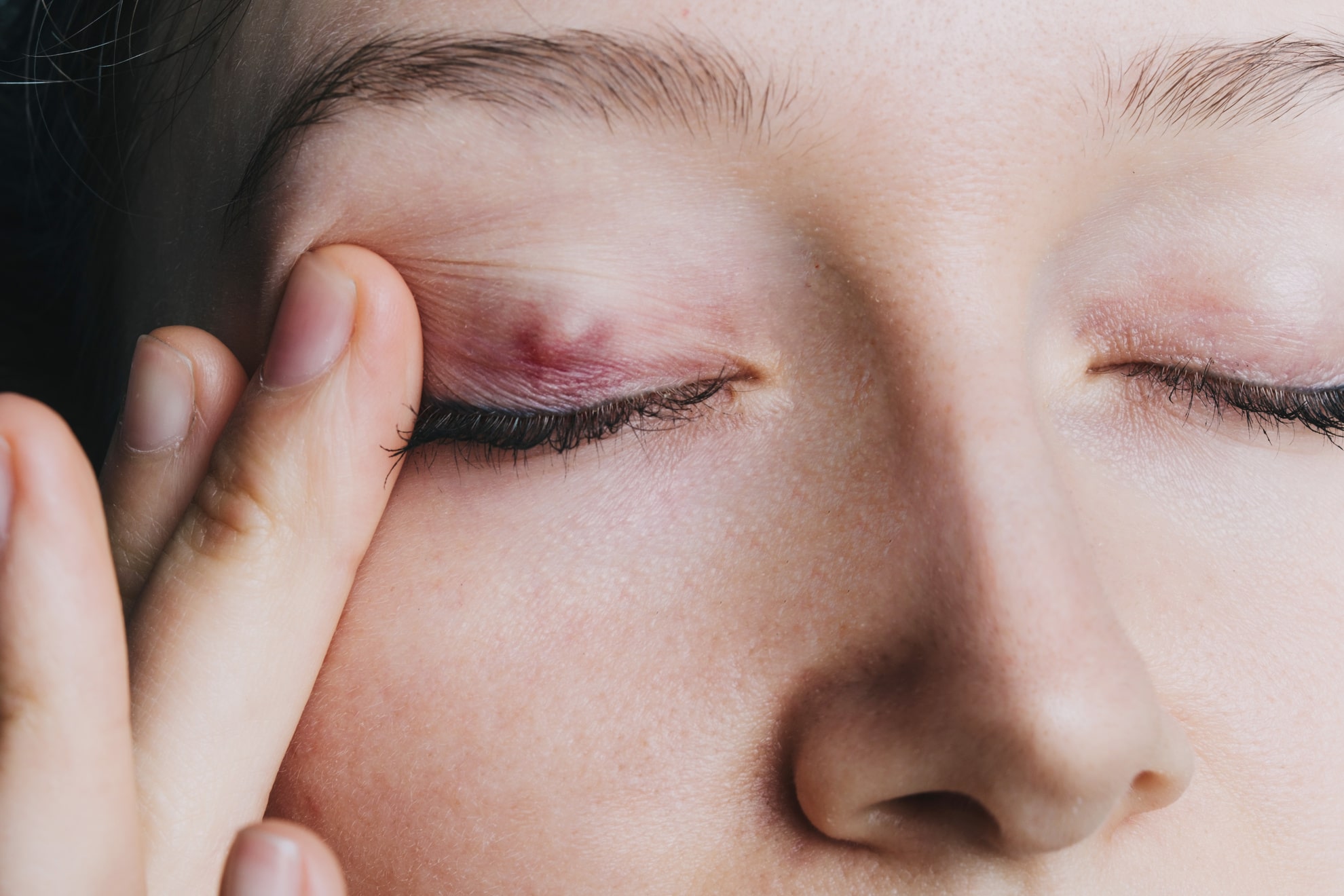 Closeup of a woman’s chalazion