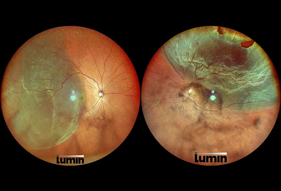 Close-up of retinal damage highlighting areas suitable for urgent Retinal Detachment Treatment.