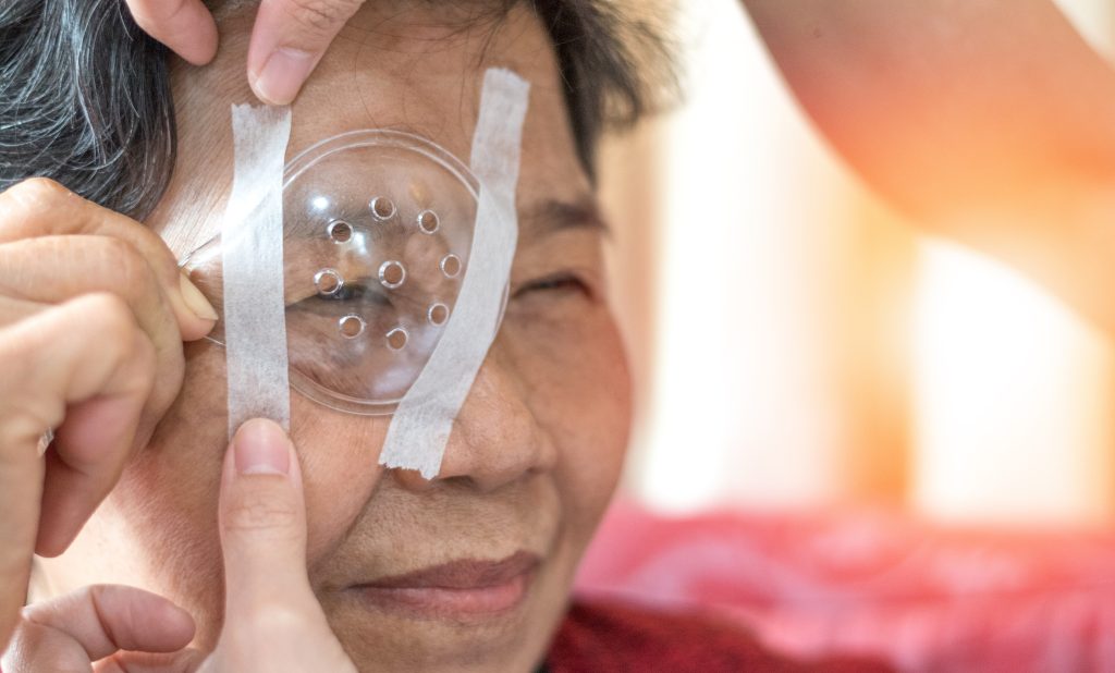 A woman wearing a protective shield over her eye after cataract surgery