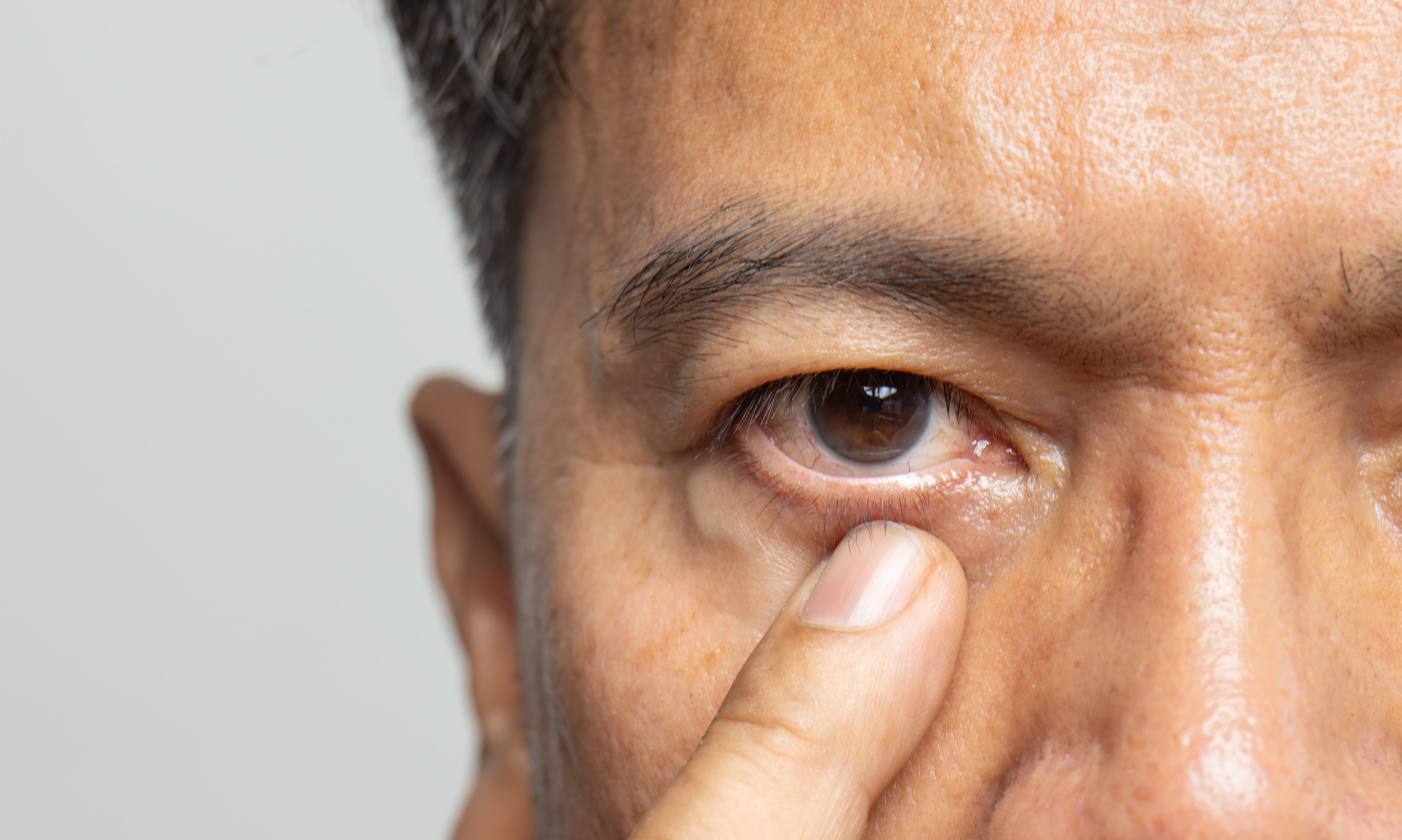 Man checking his eye during a cataract assessment for early cataract detection.