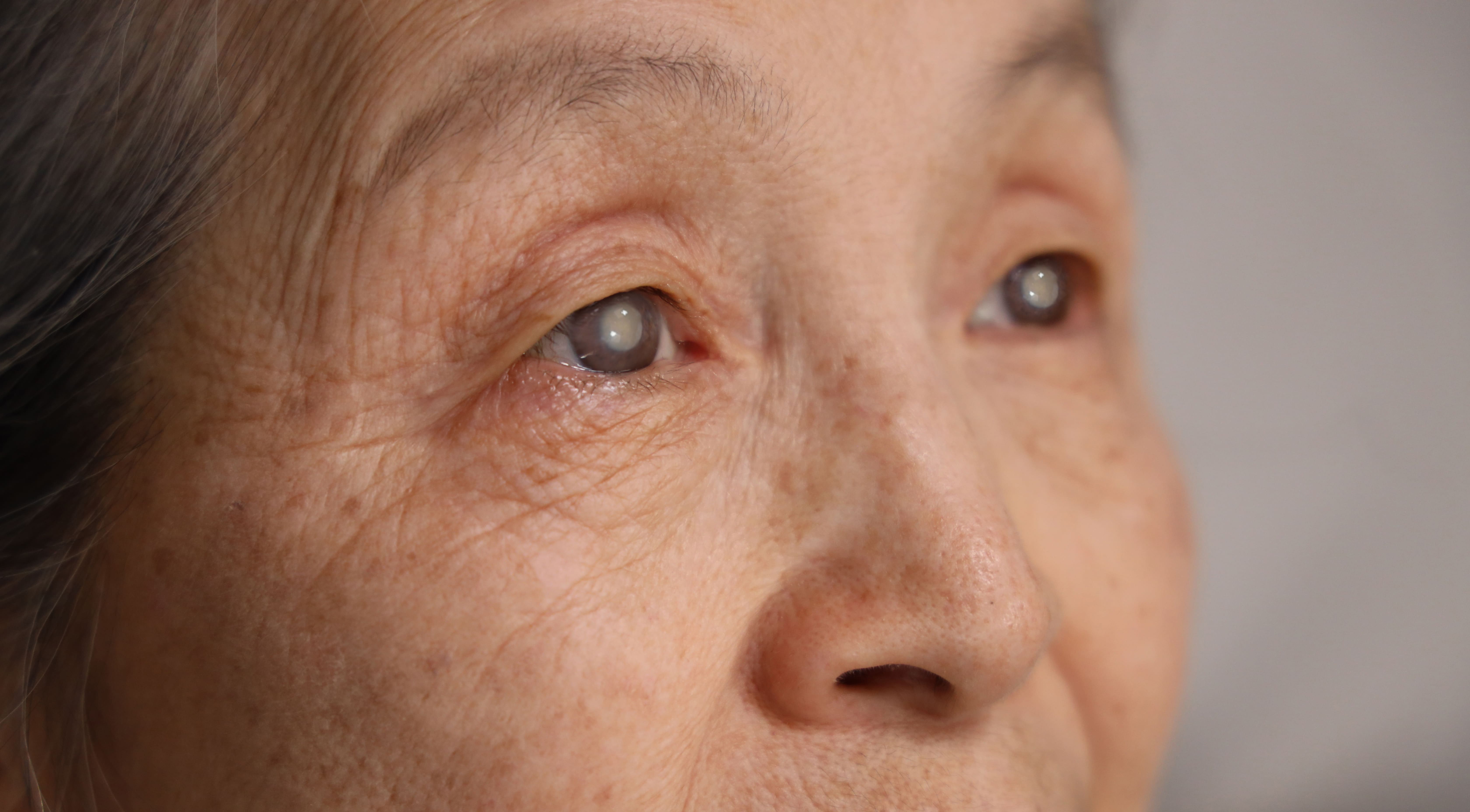 Close-up of an elderly woman’s cloudy eye showing cataract symptoms, a condition often treated with cataract surgery in Singapore.