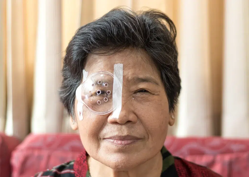 Patient wearing a protective eye shield after cataract surgery, illustrating cataract surgery recovery and post-operative eye care